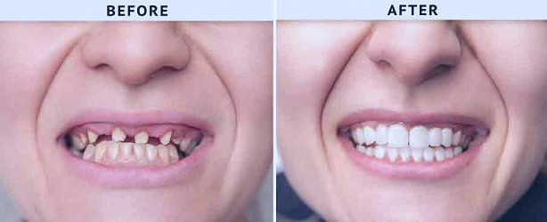 Full Mouth Reconstruction with Implants in Tijuana - BioDental Care Tijuana